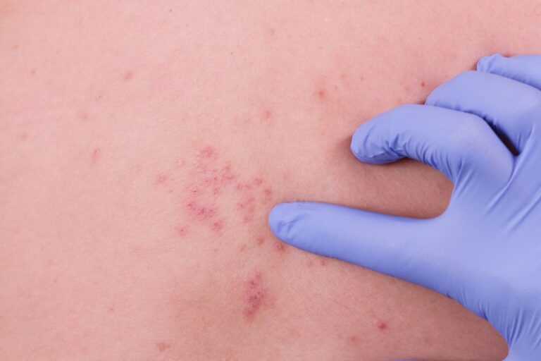 Herpes simples m dico infectologista